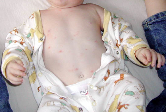 Chicken Pox Day 2 Pictures, Images & Photos | Photobucket